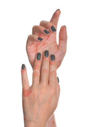 What is psoriasis?