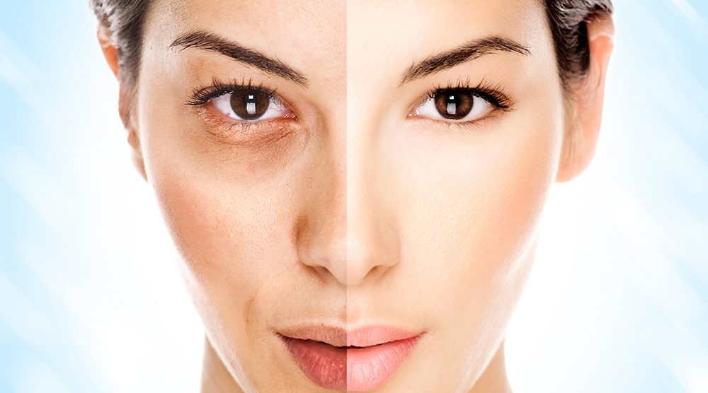 Could the sun be causing your acne?